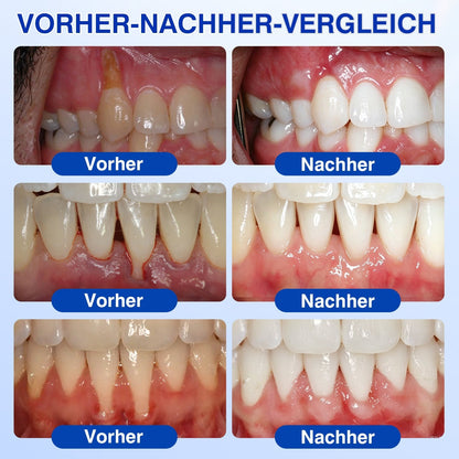 🇨🇭Glimmerly®🦷 GumRevive Parodontales Reparaturgel🌴