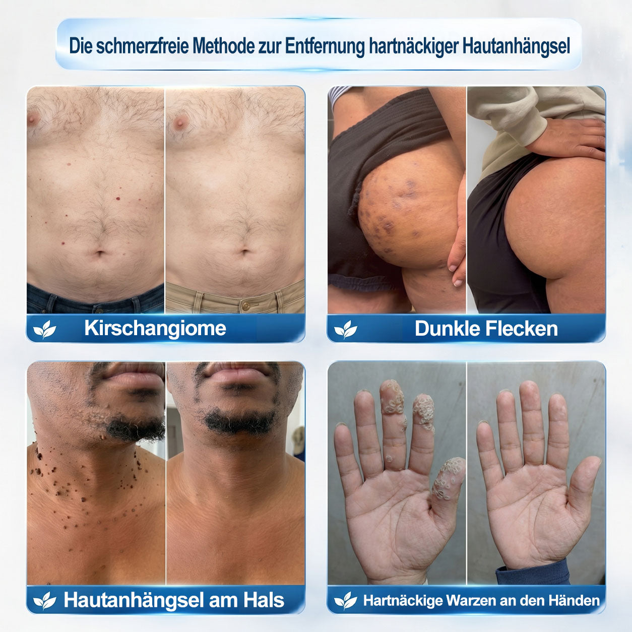 Offizieller Markenstore |👀𝑷𝑖𝒄𝐝𝐨® 7-𝑻𝒂𝒈𝒆 𝑯𝒂𝒖𝒕𝒂𝒏𝒉ä𝒏𝒈𝒔𝒆𝒍- & 𝑭𝒍𝒆𝒄𝒌𝒆𝒏𝒆𝒏𝒕𝒇𝒆𝒓𝒏𝒆𝒓(Schmerzfreier Rollerball – Keine Narbenbildung)🚀